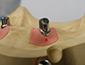 Impianti con corone primarie telescopiche Fresate al cad cam